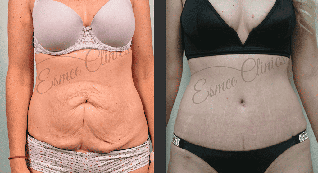 Before and After img